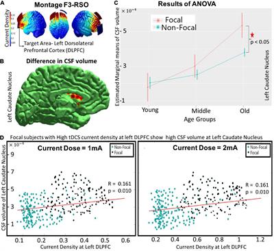 Variation of cerebrospinal fluid in specific regions regulates focality in transcranial direct current stimulation